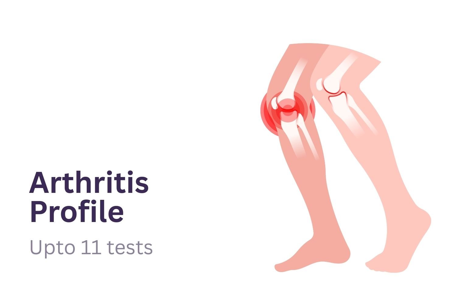 Arthritis Profile